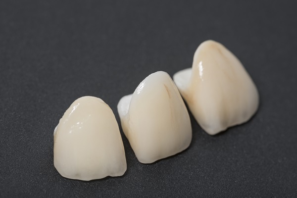 CEREC Crowns Compared To Other Restorations