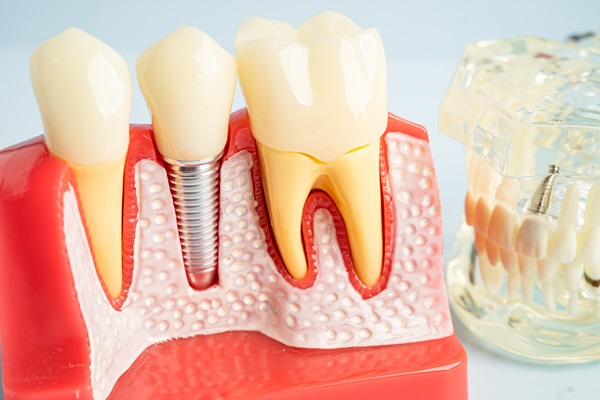 Factors To Consider If Interested In Getting A Dental Implant